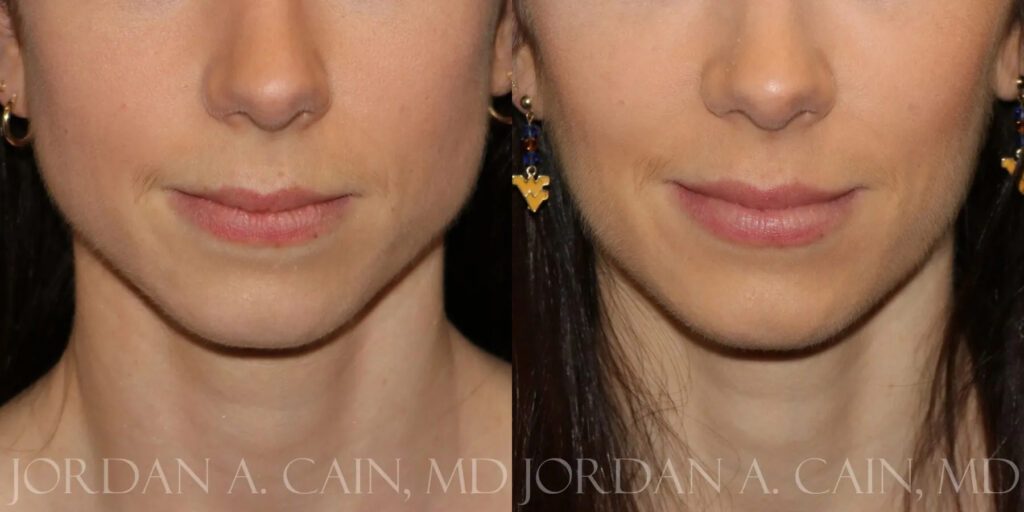 Botox Before and After photo by Texas Facial Aesthetics in Frisco, TX