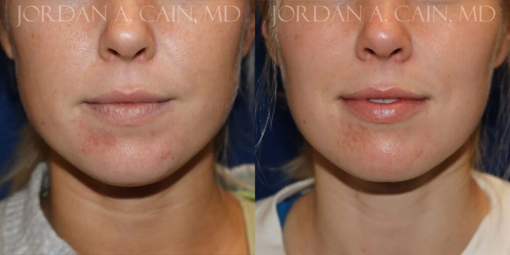 Botox Before and After photo by Texas Facial Aesthetics in Frisco, TX