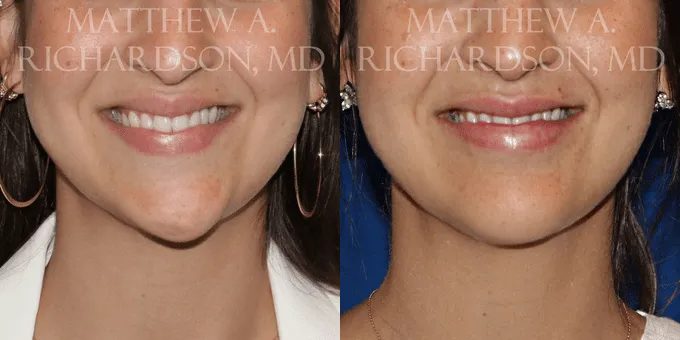 Botox Before and After photo by Texas Facial Aesthetics in Frisco, TX