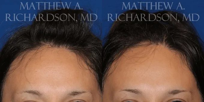 Botox Before and After photo by Texas Facial Aesthetics in Frisco, TX