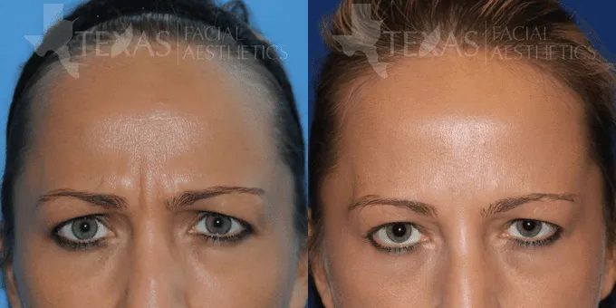 Botox Before and After photo by Texas Facial Aesthetics in Frisco, TX