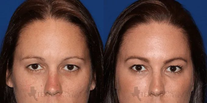 Botox Before and After photo by Texas Facial Aesthetics in Frisco, TX