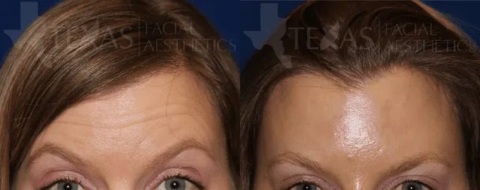 Botox Before and After photo by Texas Facial Aesthetics in Frisco, TX