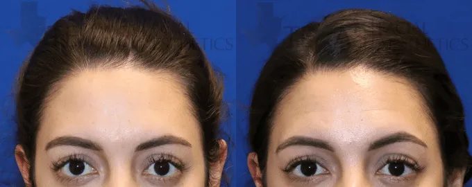 Botox Before and After photo by Texas Facial Aesthetics in Frisco, TX