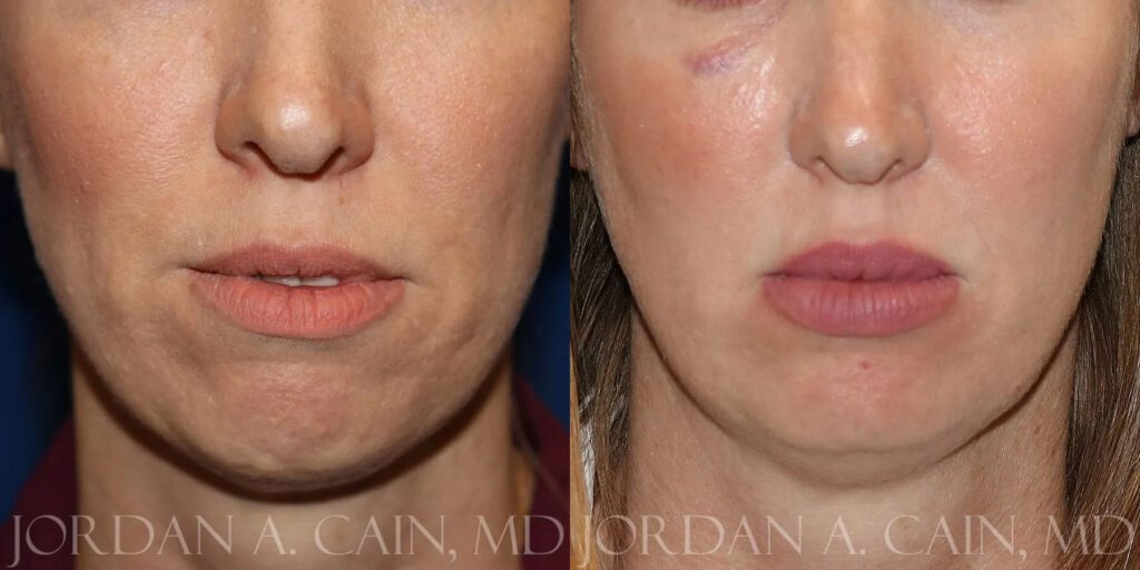 Botox Before and After photo by Texas Facial Aesthetics in Frisco, TX