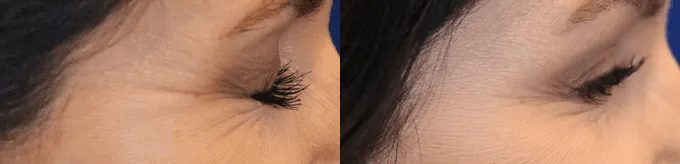 Botox Before and After photo by Texas Facial Aesthetics in Frisco, TX