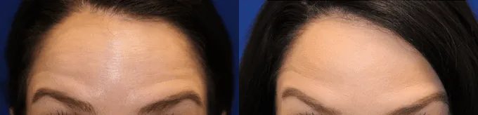 Botox Before and After photo by Texas Facial Aesthetics in Frisco, TX