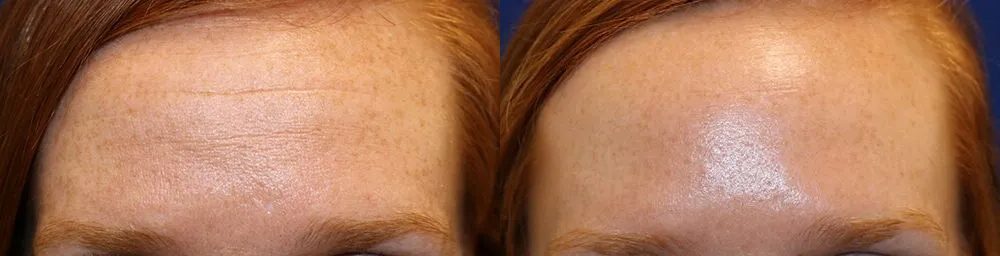 Botox Before and After photo by Texas Facial Aesthetics in Frisco, TX