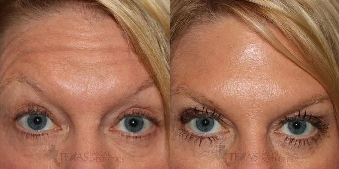 Botox Before and After photo by Texas Facial Aesthetics in Frisco, TX