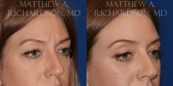 Botox Before and After photo by Texas Facial Aesthetics in Frisco, TX