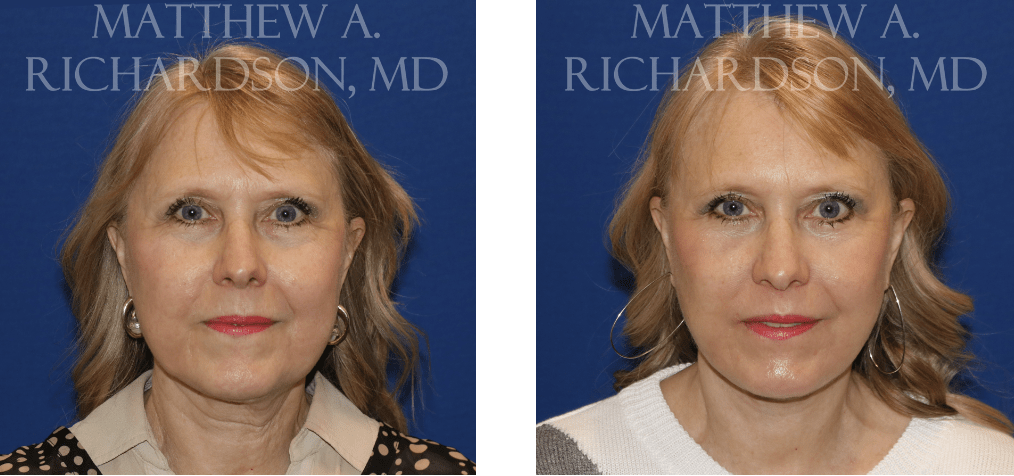 Facelift Before and After Performed by Matthew A. Richardson, MD