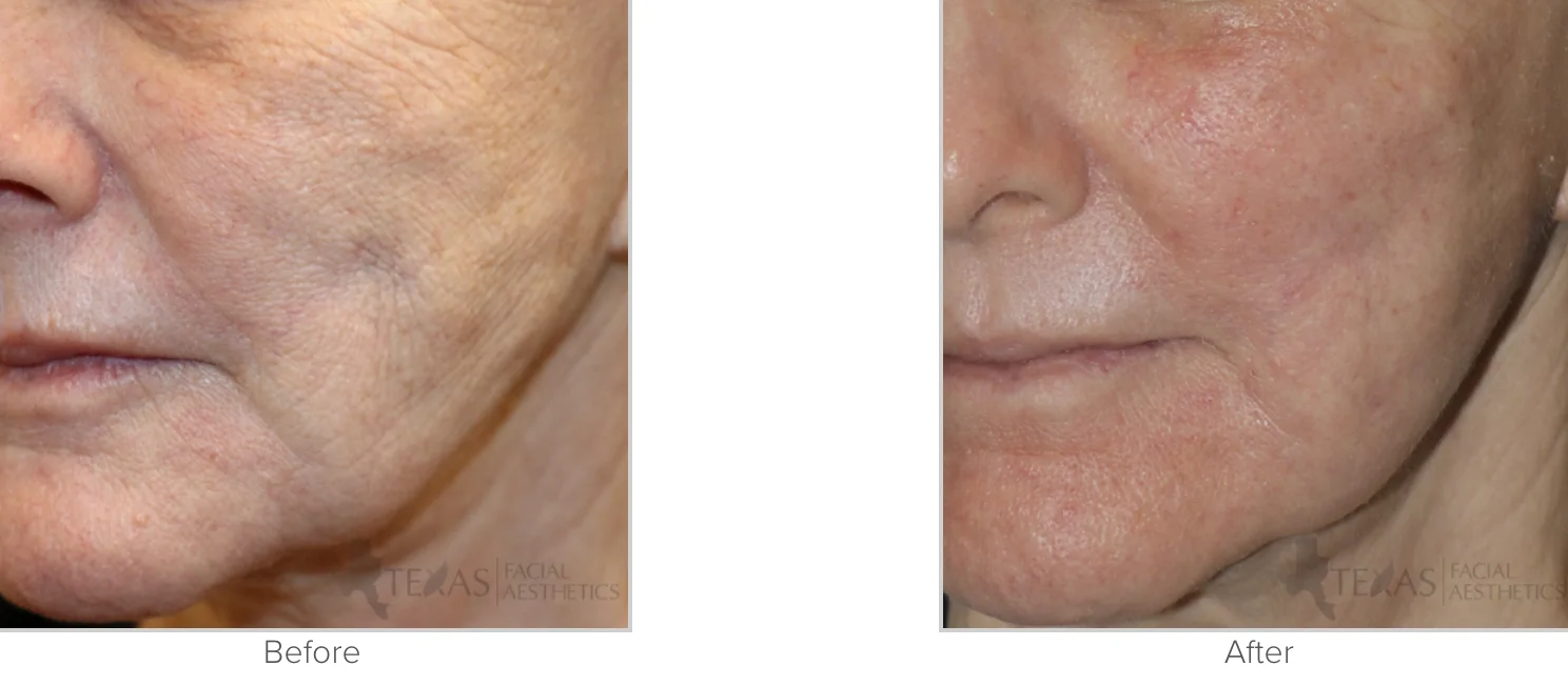 Laser Skin Resurfacing Before and After